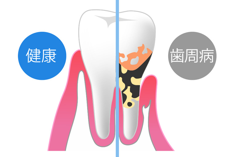 歯周病は、歯を失う最大の原因です